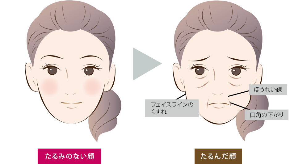 たるみのない顔 たるんだ顔の比較イラスト