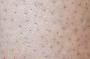 使用後 シェービング ＋ ReFa EPI GO COOL