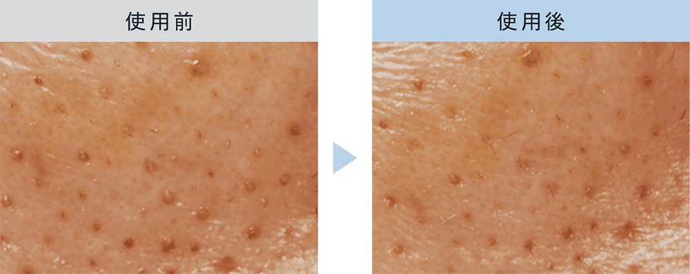 角栓がすっきり