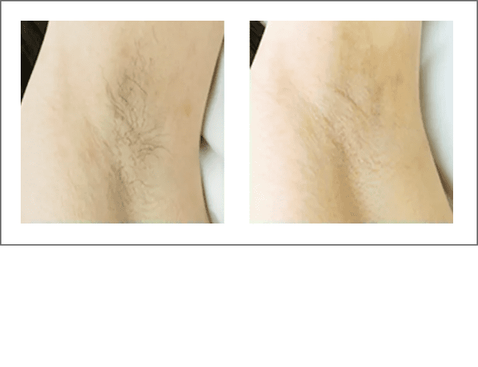 左:Before リファビューテック エピ 未使用シェービングなし　右:After シェービング済