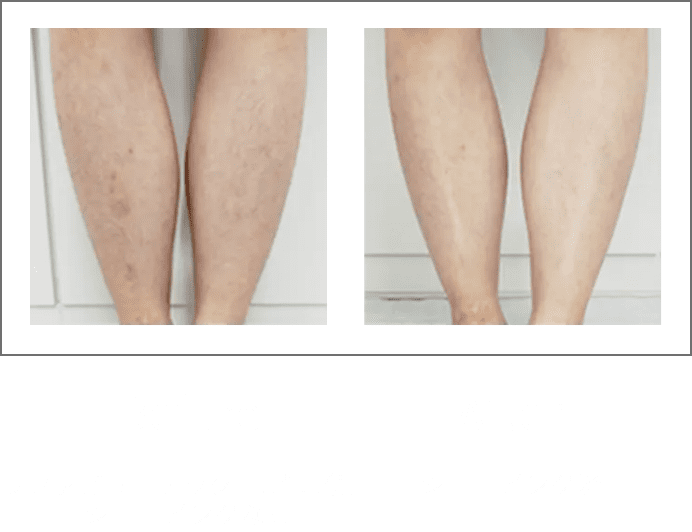 左:Before リファビューテック エピ 未使用シェービングなし　右:After シェービング済