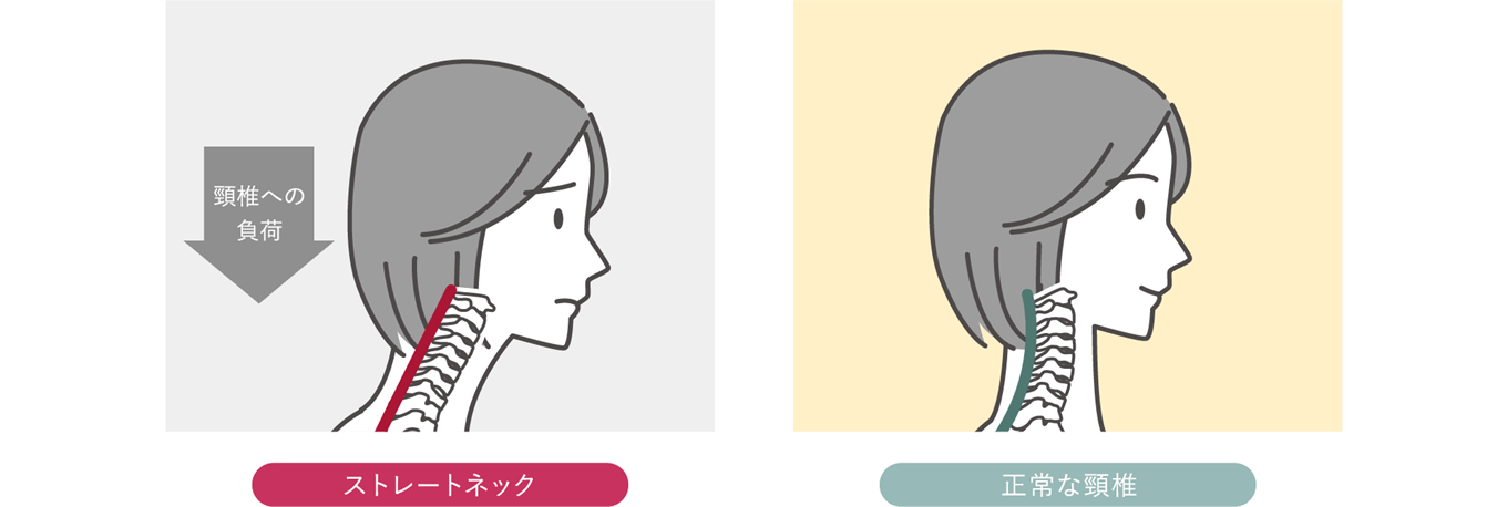ストレートネックの原因とは