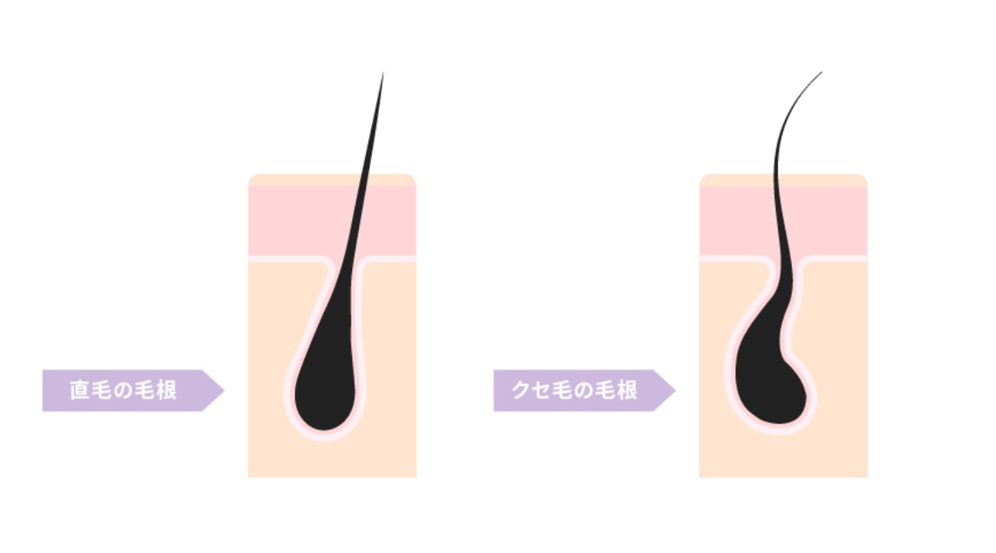 直毛の毛根とクセ毛の毛根