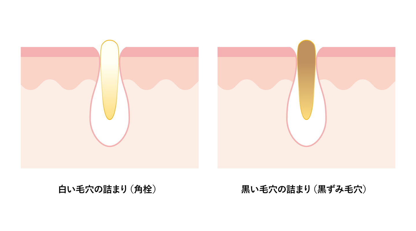 毛穴詰まりの種類と見分け方
