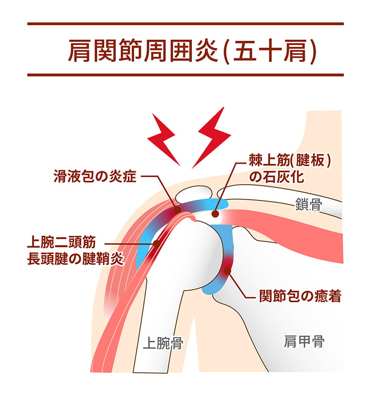 肩関節周囲炎（五十肩）
