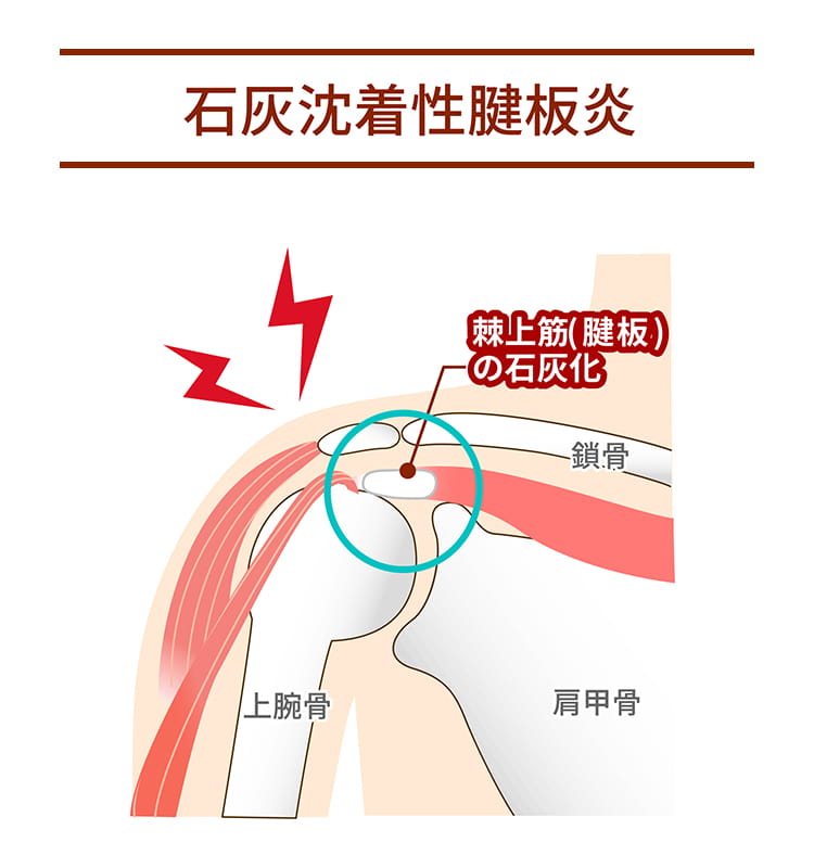 石灰沈着性腱板炎