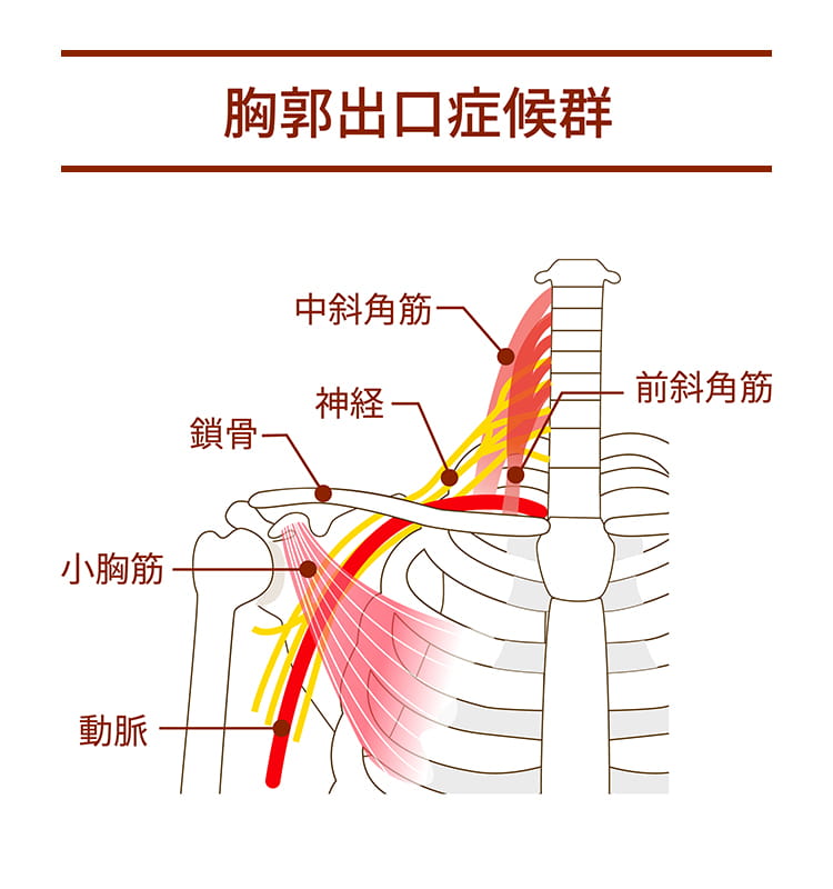 胸郭出口症候群